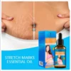 Aichun Beauty Stretch Marks Oil